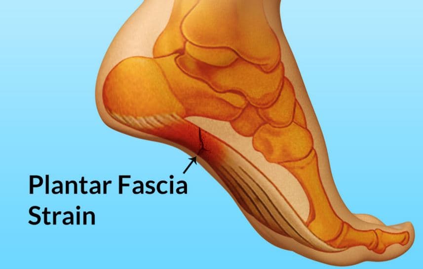 best orthotics for plantar fasciitis