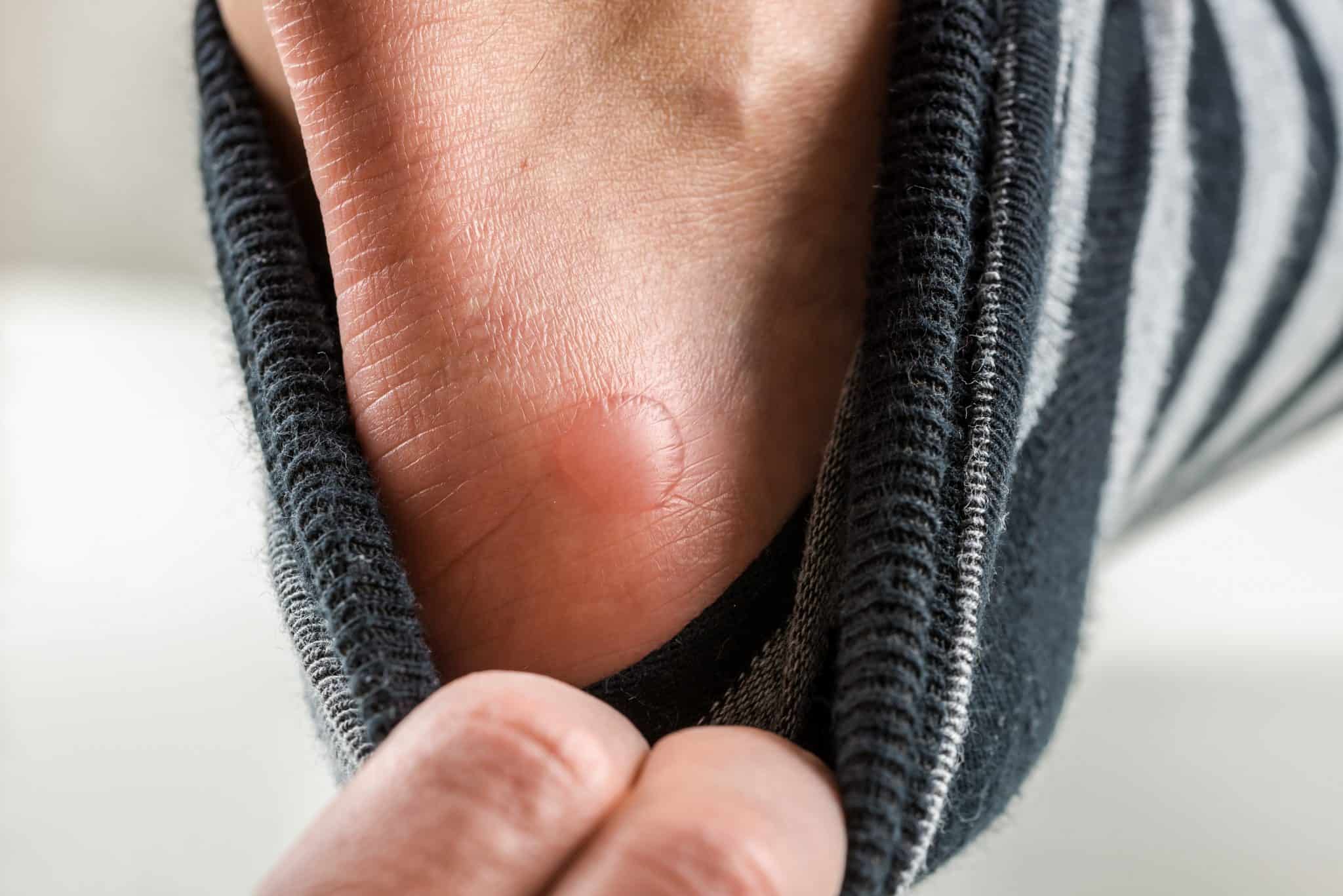 how-to-treat-a-blister-under-callus-a-much-needed-guide-for-all