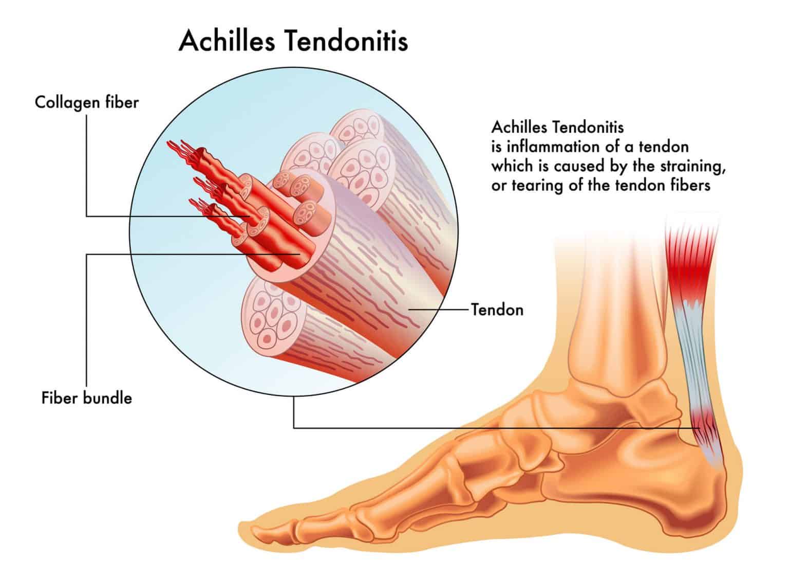 why-do-my-feet-hurt-when-i-run-10-basic-causes-and-how-to-prevent-them