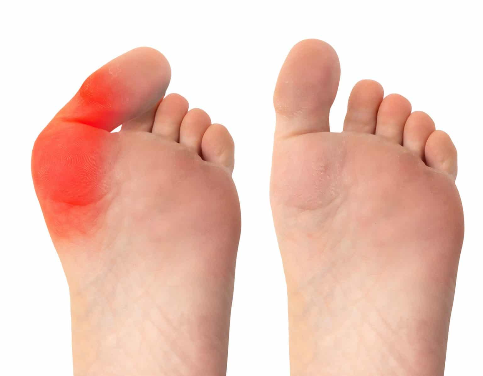 Why Do My Feet Hurt When I Run? 10 Basic Causes and How to Prevent Them Runner's Goal